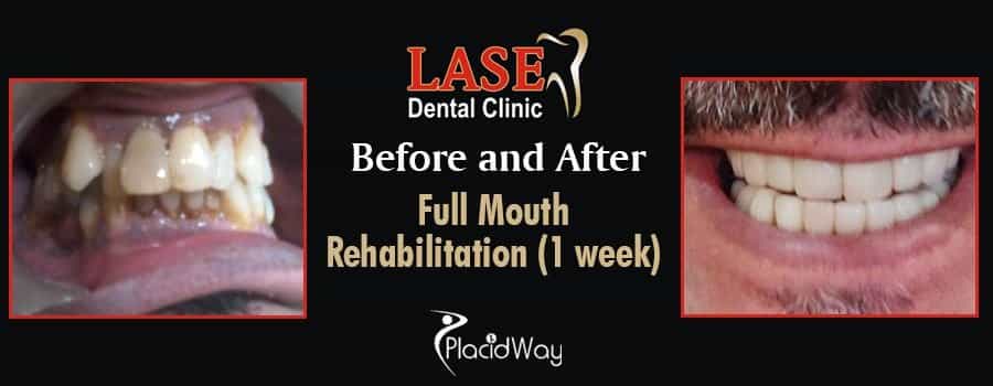 До и после стоматологической реабилитации в Мумбаи, Индия Before and After Dental Rehabilitation in Mumbai, India